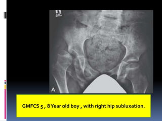 GMFCS 5 , 8Year old boy , with right hip subluxation.
 