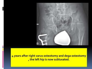 4 years after right varus osteotomy and dega osteotomy
, the left hip is now subluxated.
 