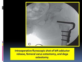 Intraoperative fluroscopic shot of left adductor
release, femoral varus osteotomy, and dega
osteotomy.
 