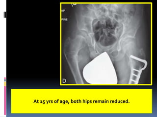 At 15 yrs of age, both hips remain reduced.
 