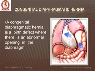 •A congenital
diaphragmatic hernia
is a birth defect where
there is an abnormal
opening in the
diaphragm.
PROGRAMME- B.Sc. Nursing Course- Child Health Nursing
 
