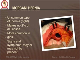 • Uncommon type
of hernia (right)
•
•
•
Makes up 2% of
all cases
More common in
girls
Signs and
symptoms may or
may not be
present
PROGRAMME- B.Sc. Nursing Course- Child Health Nursing
 