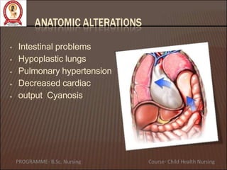 •
•
•
•
•
Intestinal problems
Hypoplastic lungs
Pulmonary hypertension
Decreased cardiac
output Cyanosis
PROGRAMME- B.Sc. Nursing Course- Child Health Nursing
 