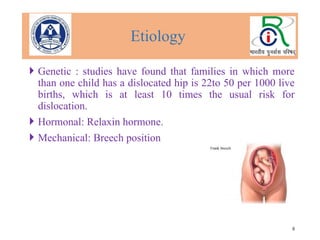 Genetic Dislocation Assessment protocol and importance of Orthotic Management of Congenital ...