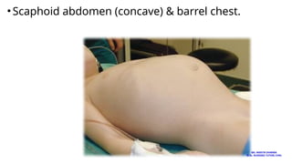 •Scaphoid abdomen (concave) & barrel chest.
MS. ANEETA SHARMA
M.Sc. NURSING TUTOR( CHN)
 