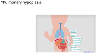 Pulmonary hypoplasia.
MS. ANEETA SHARMA
M.Sc. NURSING TUTOR( CHN)
 
