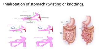 •Malrotation of stomach (twisting or knotting).
 