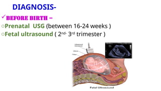 DIAGNOSIS-
BEFORE BIRTH –
oPrenatal USG (between 16-24 weeks )
oFetal ultrasound ( 2nd-
3rd
trimester )
 
