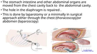 • The stomach intestine and other abdominal organs are
moved from the chest cavity back to the abdominal cavity.
• The hole in the diaphragm is repaired .
• This is done by laparotomy or a minimally in surgical
approach either through the chest (thoracoscopy)or
abdomen (laparoscopy)
MS. ANEETA SHARMA
M.Sc. NURSING TUTOR( CHN)
 