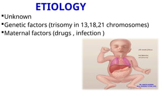 ETIOLOGY
Unknown
Genetic factors (trisomy in 13,18,21 chromosomes)
Maternal factors (drugs , infection )
MS. ANEETA SHARMA
M.Sc. NURSING TUTOR( CHN)
 