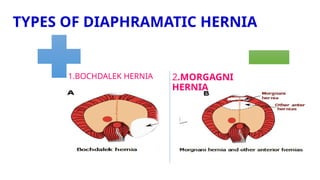 TYPES OF DIAPHRAMATIC HERNIA
1.BOCHDALEK HERNIA 2.MORGAGNI
HERNIA
 