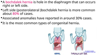 A bochdalek hernia is hole in the diaphragm that can occurs
right or left side.
Left side (posterolateral )bochdalek hernia is more common
about 80% of cases.
Associated anomalies have reported in around 30% cases.
It is the most common types of congenital hernia.
MS. ANEETA SHARMA
M.Sc. NURSING TUTOR( CHN)
 