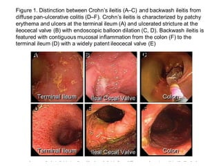 Grading Crohn's disease activity
Các phát hiện cần quan tâm:
• Vị trí của tổn thương
(Location of the lesions)
• Độ dày th...