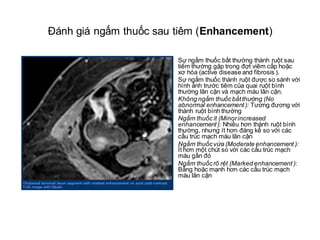 Hình ảnh rò ruột non- ruột non kèm ổ áp xe ở bN nữ 23 tuổi sau phẫu thuật cắt đoạn hồi
tràng do bệnh Crohn. Hiện tại có đa...