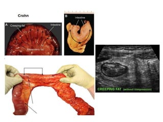 Bệnh Crohn (Viêm đại tràng hạt-
Colite granulomateuse):
3 vị trí phổ biến nhất của bệnh Crohn:
- Hồi tràng+ Đại tràng
- Đo...