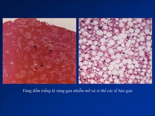 Vùng đốm trắng là vùng gan nhiễm mỡ và vi thể các tế bào gan
 