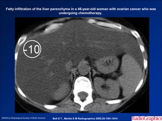 Fatty infiltration of the liver parenchyma in a 46-year-old woman with ovarian cancer who was
                                         undergoing chemotherapy.




©2009 by Radiological Society of North America   Boll D T , Merkle E M Radiographics 2009;29:1591-1614
 