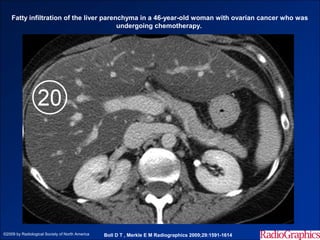 Fatty infiltration of the liver parenchyma in a 46-year-old woman with ovarian cancer who was
                                         undergoing chemotherapy.




©2009 by Radiological Society of North America   Boll D T , Merkle E M Radiographics 2009;29:1591-1614
 