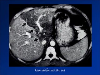 Gan nhiễm mỡ khu trú
 