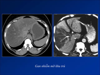 Gan nhiễm mỡ khu trú
 