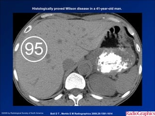 Histologically proved Wilson disease in a 41-year-old man.




©2009 by Radiological Society of North America   Boll D T , Merkle E M Radiographics 2009;29:1591-1614
 