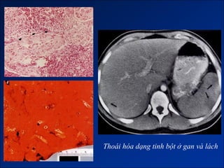 Thoái hóa dạng tinh bột ở gan và lách
 