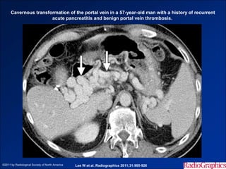 Cavernous transformation of the portal vein in a 57-year-old man with a history of recurrent
                       acute pancreatitis and benign portal vein thrombosis.




©2011 by Radiological Society of North America   Lee W et al. Radiographics 2011;31:905-926
 