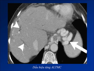 Dấu hiệu tăng ALTMC
 