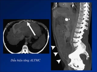 Dấu hiệu tăng ALTMC
 