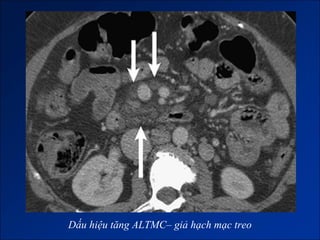 Dấu hiệu tăng ALTMC– giả hạch mạc treo
 