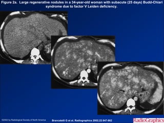 Figure 2a. Large regenerative nodules in a 34-year-old woman with subacute (25 days) Budd-Chiari
                           syndrome due to factor V Leiden deficiency.




©2002 by Radiological Society of North America   Brancatelli G et al. Radiographics 2002;22:847-862
 
