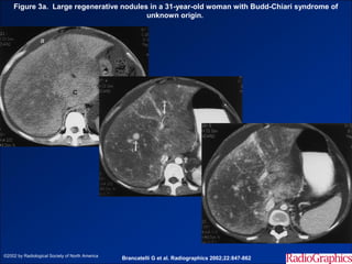 Figure 3a. Large regenerative nodules in a 31-year-old woman with Budd-Chiari syndrome of
                                         unknown origin.




©2002 by Radiological Society of North America
                                                 Brancatelli G et al. Radiographics 2002;22:847-862
 