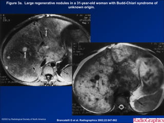 Figure 3a. Large regenerative nodules in a 31-year-old woman with Budd-Chiari syndrome of
                                         unknown origin.




©2002 by Radiological Society of North America
                                                 Brancatelli G et al. Radiographics 2002;22:847-862
 