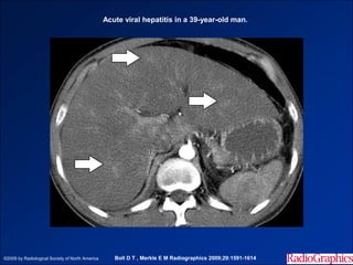 Acute viral hepatitis in a 39-year-old man.




©2009 by Radiological Society of North America      Boll D T , Merkle E M Radiographics 2009;29:1591-1614
 
