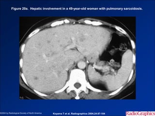 Figure 20a. Hepatic involvement in a 49-year-old woman with pulmonary sarcoidosis.




©2004 by Radiological Society of North America   Koyama T et al. Radiographics 2004;24:87-104
 