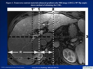 Figure 1. Transverse contrast material-enhanced gradient-echo MR image (120/2.3, 90° flip angle)
                                       shows method of obtaining the C/RL.




©2002 by Radiological Society of North America   Awaya H et al. Radiology 2002;224:769-774
 