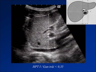 HPT I / Gan trái < 0,35
 