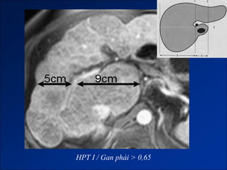 HPT I / Gan phải > 0,65
 
