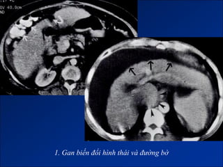 1. Gan biến đổi hình thái và đường bờ
 