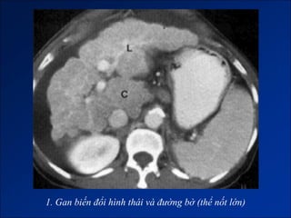 1. Gan biến đổi hình thái và đường bờ (thể nốt lớn)
 