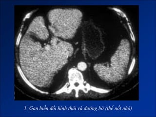 1. Gan biến đổi hình thái và đường bờ (thể nốt nhỏ)
 