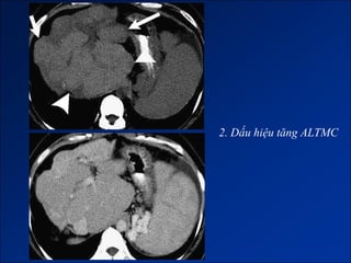 2. Dấu hiệu tăng ALTMC
 