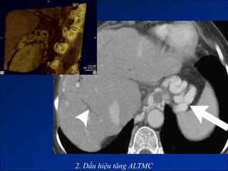 2. Dấu hiệu tăng ALTMC
 
