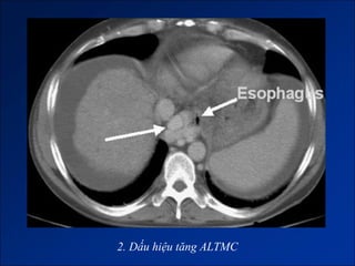 2. Dấu hiệu tăng ALTMC
 