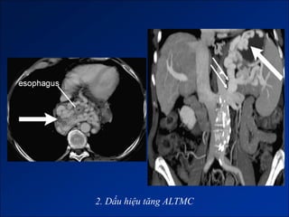 2. Dấu hiệu tăng ALTMC
 
