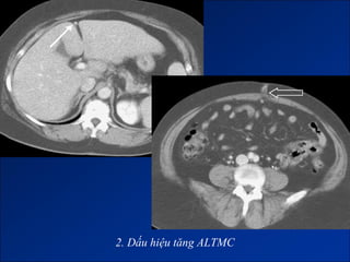 2. Dấu hiệu tăng ALTMC
 