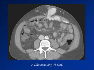 2. Dấu hiệu tăng ALTMC
 