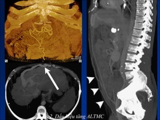 2. Dấu hiệu tăng ALTMC
 
