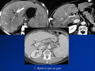 1. Bệnh lý giả xơ gan
 