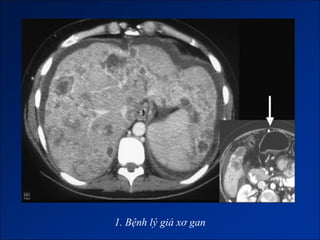 1. Bệnh lý giả xơ gan
 